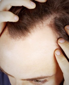 behandla alopecia